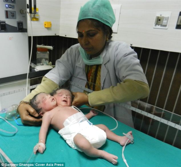 This Baby Was Just Born With 2 Heads And Survived. This Is Unbelievable.