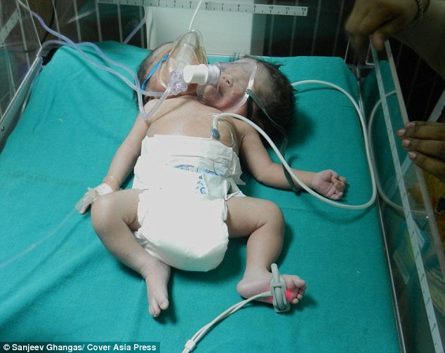 This Baby Was Just Born With 2 Heads And Survived. This Is Unbelievable.